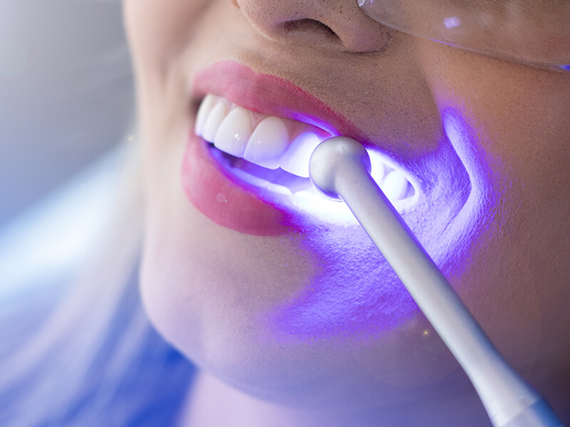 clareamento dental