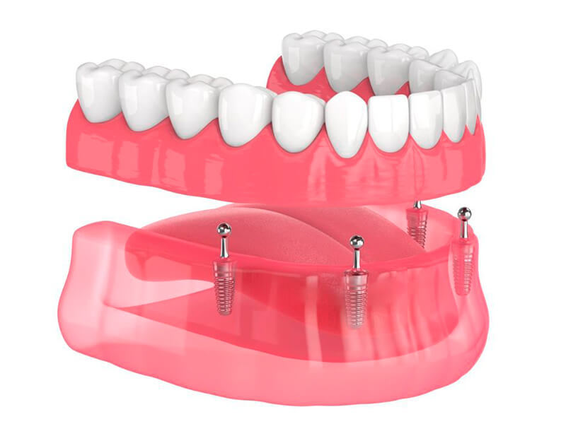implante dentário